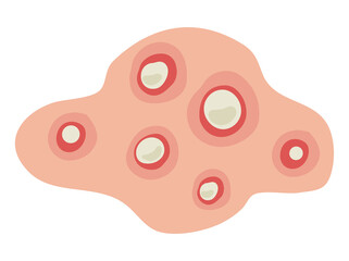 Hand Drawn Acne Pustule in Skin
