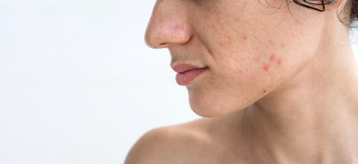 portrait of a young teenage girl with pimples and acne on problematic facial skin. Face of female with bad red inflamed skin and acne in close-up on a white isolated background