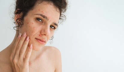 portrait of teen girl with pimples and acne on problematic facial skin. Face of young woman with bad red inflamed skin and acne in close-up on a white background