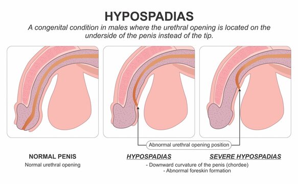 Hypospadias Congenital Condition Medical Infographic Flashcard