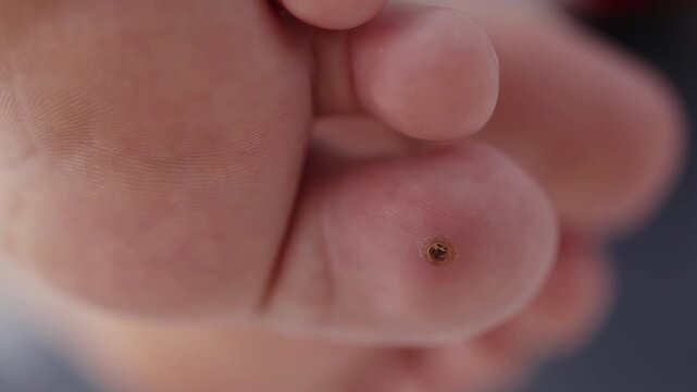 Macro view of plantar wart situated on sole of human foot, specifically on one toe. Lesion displays characteristic dark center and rough texture, indicating viral infection.