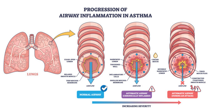 Airway inflammation progression in asthma shows normal to attack stages, with narrowing and mucus blocking airflow, lungs, bronchiole cross-sections, mucus plug. Outline diagram