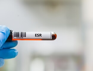 Obraz premium Blood sample tube for erythrocyte sedimentation rate (ESR) test analysis.
