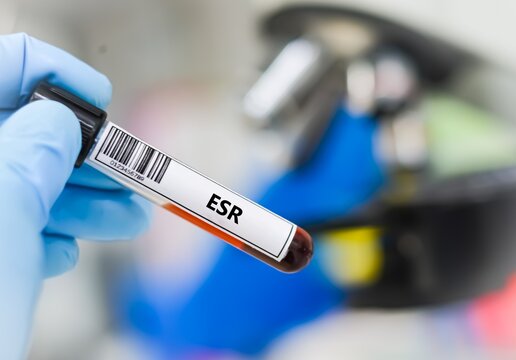 Blood sample tube for erythrocyte sedimentation rate (ESR) test analysis