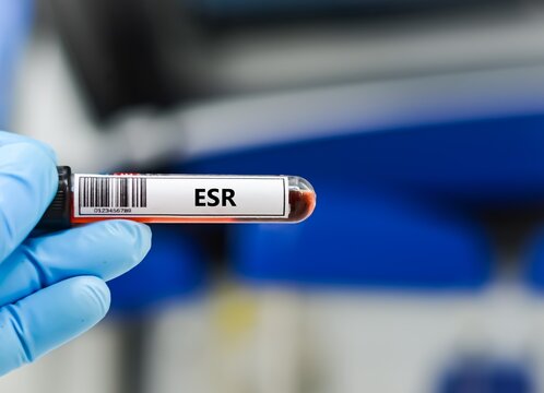 Blood sample tube for erythrocyte sedimentation rate (ESR) test analysis