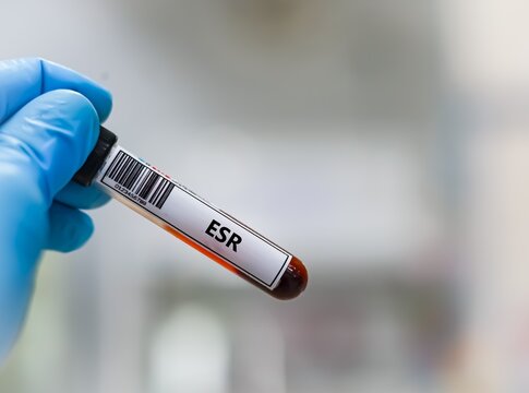 Blood sample tube for erythrocyte sedimentation rate test analysis.