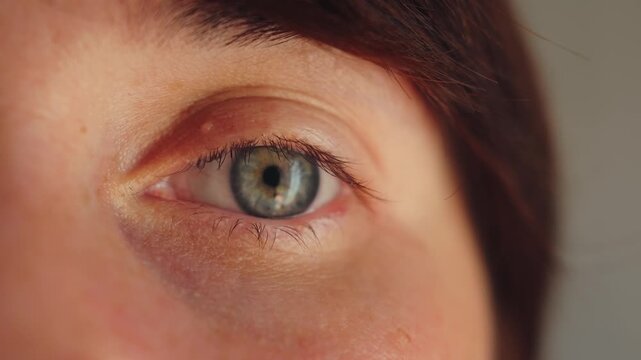 Milia on a woman's upper eyelid harmless, tiny white bumps from trapped keratin under the skin, and appearing like small cysts. High quality 4k footage