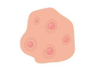 Acne Nodule Clip Art Illustration
