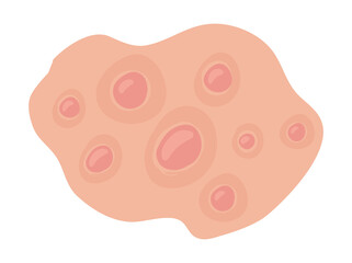 Hand Drawn Acne Nodule in Skin