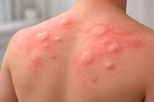 3D realistic hives on the back or shoulder, medium crop showing scattered transient wheals of varying sizes, slightly elevated and smooth with mild redness, skin fully intact