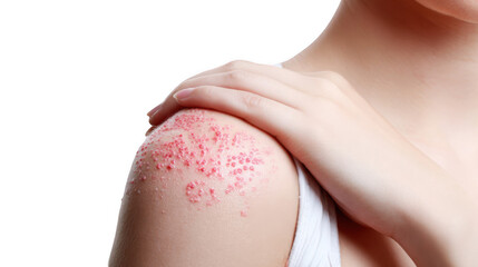 Close up of a man's shoulder displaying chickenpox rash and blisters, emphasizing the contagious nature of the varicella zoster virus against a transparent background