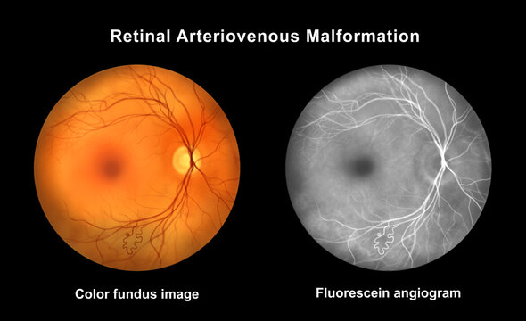Retinal arteriovenous malformation, illustration
