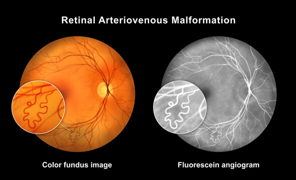 Retinal arteriovenous malformation, illustration