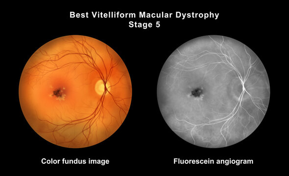 Best disease stage 5, illustration
