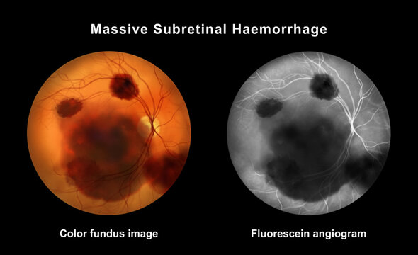 Massive subretinal hemorrhage, illustration