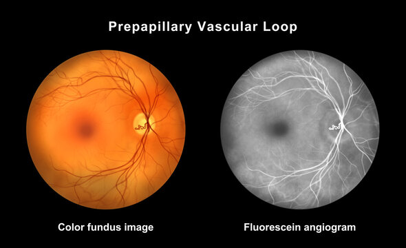 Prepapillary vascular loop, illustration