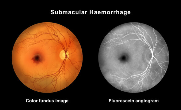 Submacular hemorrhage, illustration