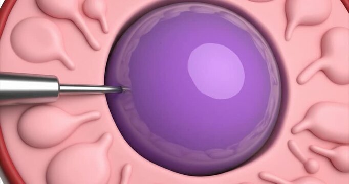3D animation of follicle aspiration needle. Oocyte retrieval.