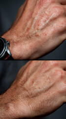 Naklejka premium Before and after collage of aging hands with pigmentation spots for cosmetic and dermatology uses 