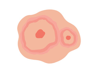 Erythema Migrans in Skin Illustration