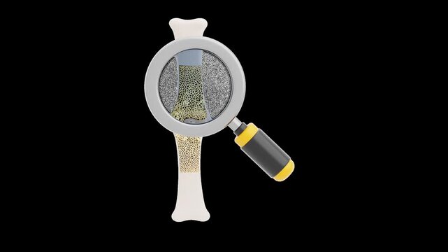 3D Osteoporosis and magnifying glass | Alpha Channel