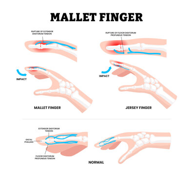 Mallet and Jersey finger tendon injury at the fingertip DIP joint. Labeled ruptured of or flexor extensor digitorum tendon. Inability to straighten and bend the tip. Healthcare medical illustration.