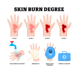 Stages of skin burn degree stages. First aid for burn wound. Fire damage to skin classification. Hand blisters. treatment for thermal wound with cold water, bandage, ice bag cold compress.
