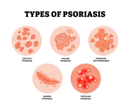 Different types of psoriasis skin derma disease. Labeled guttate, vulgar, inverse, pustular psoriasis and psoriatic erythroderma. Dermatology allergy, medical itch and rash, symptom of epidermis.