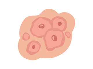 Erythema Multiforme in Skin Illustration
