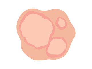 Hand Drawn Erythema Marginatum Redness
