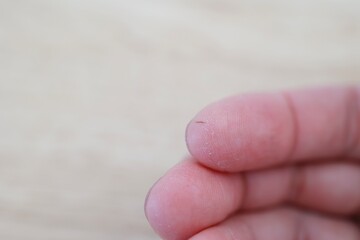 乾燥であかぎれができた指先のクローズアップ。