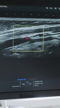 color Doppler ultrasound showing vascular blood flow in superficial vessel, realtime color mapping highlights red and blue flow within lumen while probe sweeps across muscle and tissue, measurement