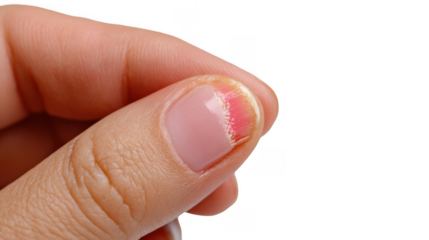 Woman showing injured finger with painful subungual hematoma under fingernail, isolated on transparent background, demonstrating common household injury