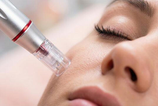 Close-up of a woman receiving a facial microneedling treatment with a cosmetic skin needling pen