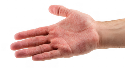 Close up of a hand and wrist exhibiting symptoms of eczema, characterized by redness, irritation, and inflammation against a transparent background, emphasizing the skin condition's impact