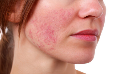 Fototapeta premium Close up of a woman's face with visible rash symptoms, potentially indicating a skin condition like lupus, isolated on a transparent background for easy integration into various projects
