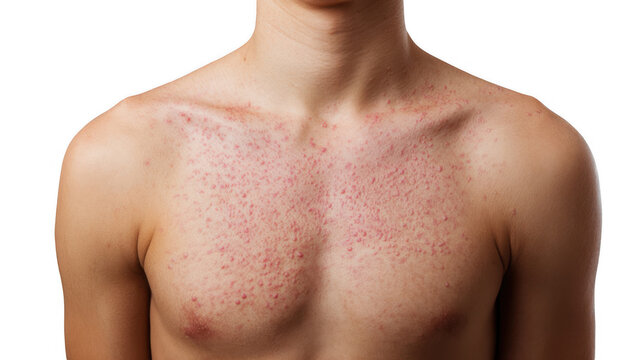 Close up of a man's chest and shoulder exhibiting a measles rash, highlighting the characteristic red spots and skin irritation against a transparent background
