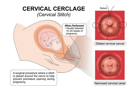 Cervical Cerclage (Cervical Stitch) Pregnancy Medical Infographic Flashcard