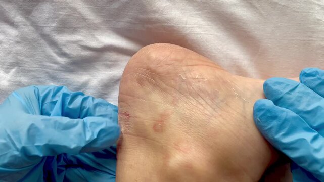 Dermatological foot examination: dry and peeling skin on the heel. Clinical signs of fungal infection, tinea pedis, hyperkeratosis, or dermatitis. Doctor in medical gloves performing diagnostics