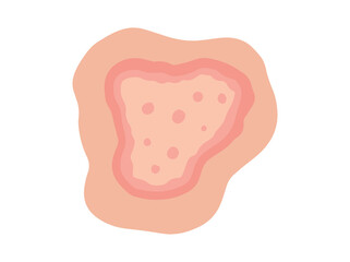 Hand Drawn Dermatophytosis or Dermatophytes
