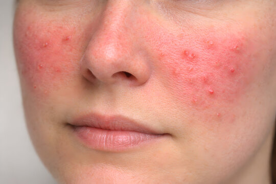 Photorealistic 3D medical depiction of rosacea (erythematotelangiectatic type), close-up of mid-face focusing on cheeks and nose with diffuse symmetrical redness and subtle visible fine capillaries