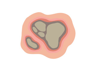 Necrosis Dead Tissue in Skin