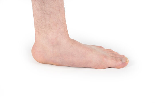Human bare foot displaying the pes planus condition, characterized by a flattened arch, providing a clear visual for medical education and orthopedic health issues
