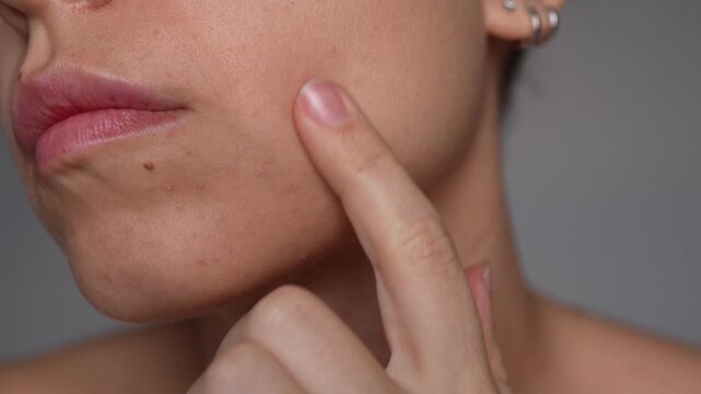 Young woman touching her face with small pimples and uneven skin texture. Natural skin imperfections, skincare and dermatology concept, sensitive skin, beauty realism, cosmetic care