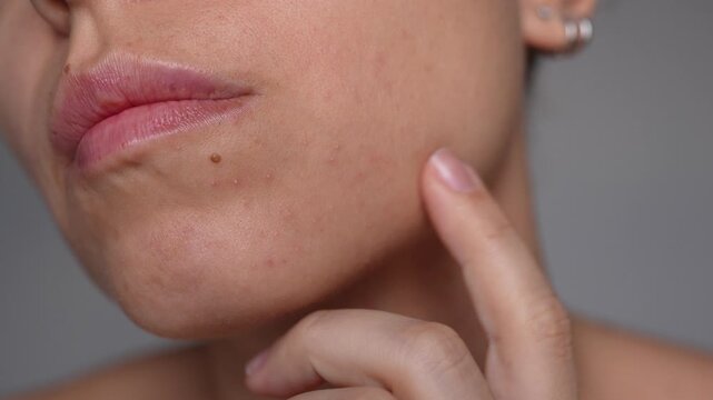 Young woman touching her chin with small pimples with her hand. Natural skin condition, skincare and dermatology concept, sensitive skin, beauty realism, cosmetic care and skin health