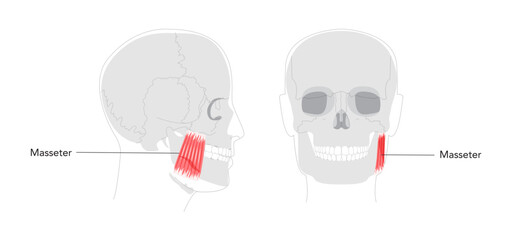 Masseter - Human chewing muscle shown in labeled diagram responsible for elevating the mandible, crucial for biting and grinding, depicted in medical illustration for dental and anatomical education.