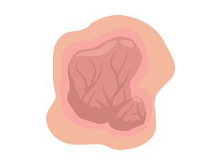 Hand Drawn Tumor Solid Mass
