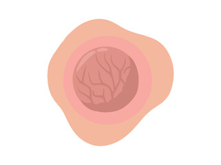 Tumor Solid Mass Clip Art
