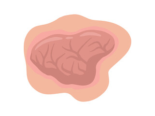 Tumor Solid Mass in Skin
