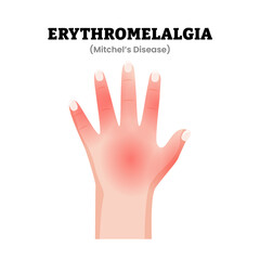 Obraz premium Erythromelalgia Hand Disorder or Mitchel's Disease Symptoms Medical Illustration. Showing red painful skin with increased temperature. Dermatology. Rare vascular disorder. Flat vector illustration.